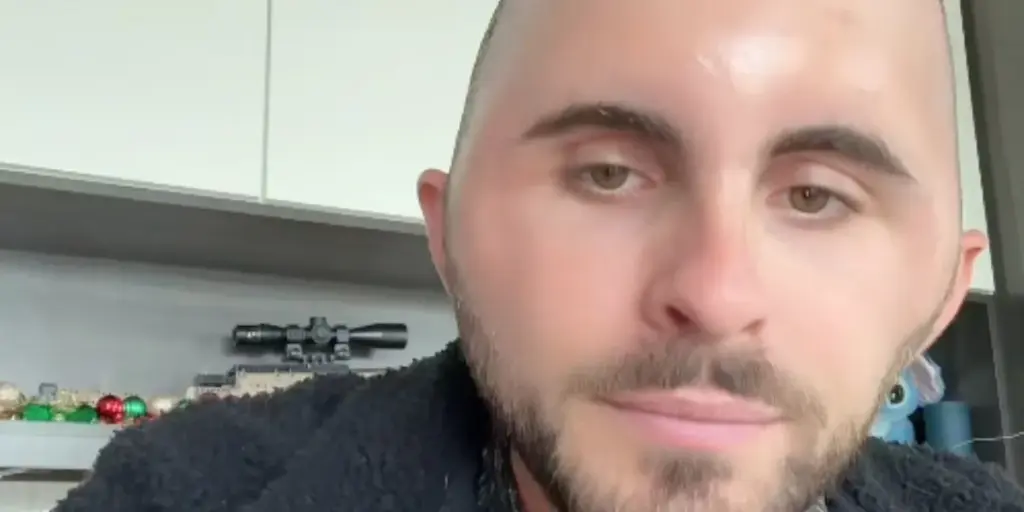 Hårtransplantation gik galt for 27-årig: Endte med ansigt som ‘æg’ – men fortryder ikke