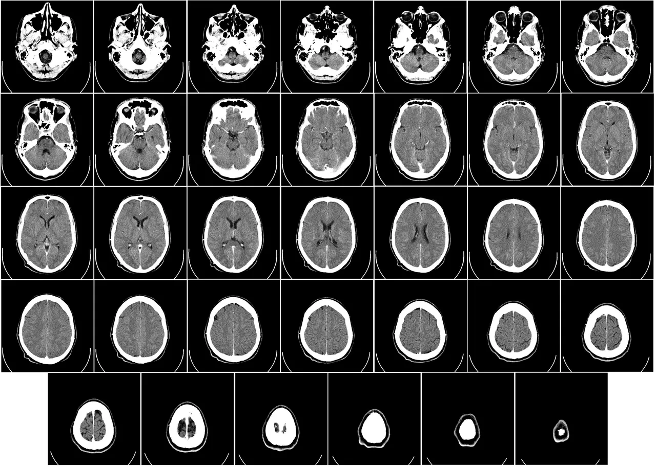 A computed tomography (CT) scan showing the human brain from the base of the skull to the top, with intravenous contrast medium highlighting anatomical structures.