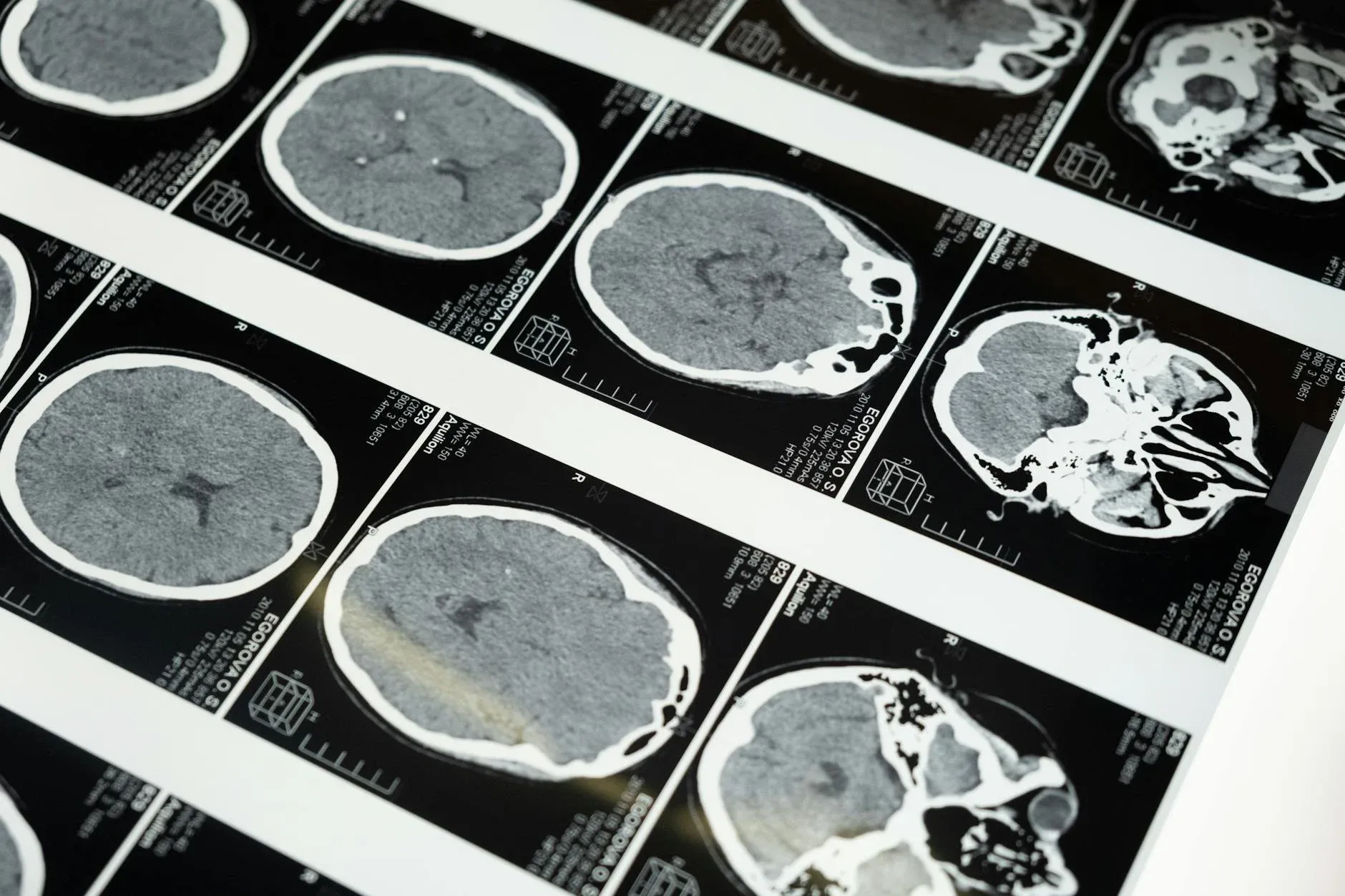 These detailed brain MRI scans are displayed on a lightbox, highlighting advanced medical imaging techniques.